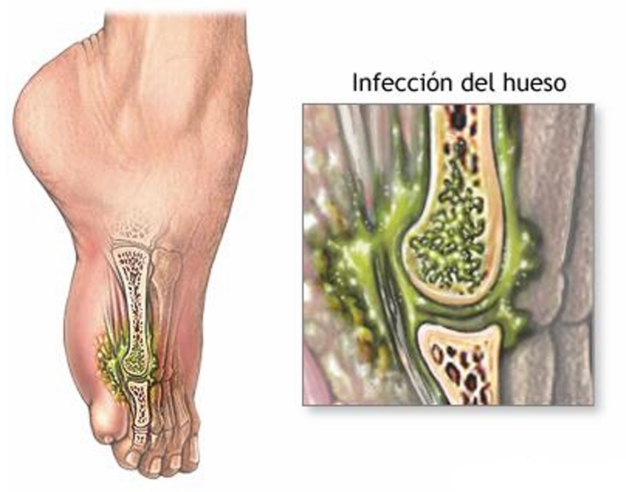 Osteomielitis