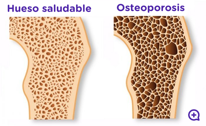 Osteoporosis